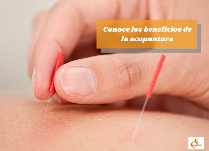 ¿Conoces los beneficios de la acupuntura?